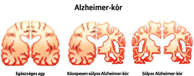 Alzheimer vilgnap